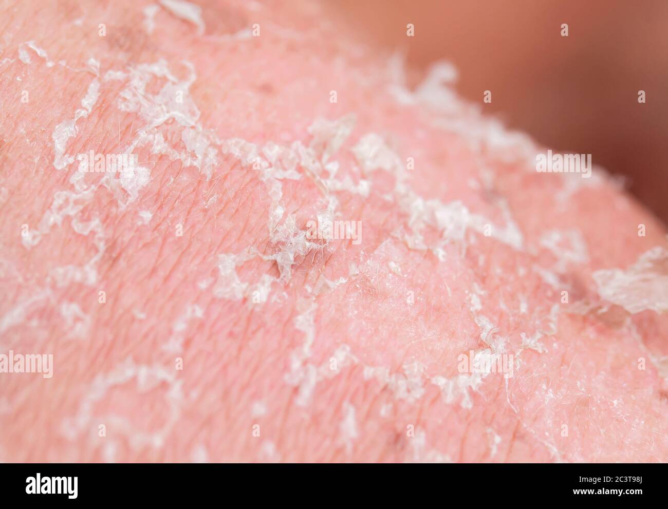 Texturierter Hintergrund mit Schuppen von abgestorbenen Hautzellen mit Rissen nach Sonnenbrand brechen aus dem Körper bedeckt Stockfoto