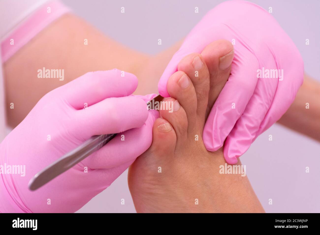 Die Hände einer nicht erkennbaren weiblichen Podologin mit rosa Handschuhen, die den Hornhaut einen Fuß mit einem Skalpell abschneiden Stockfoto