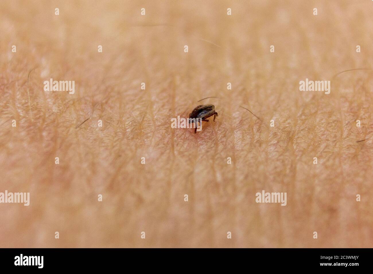 Detail Makro ticken in der menschlichen Haut gebissen Stockfoto