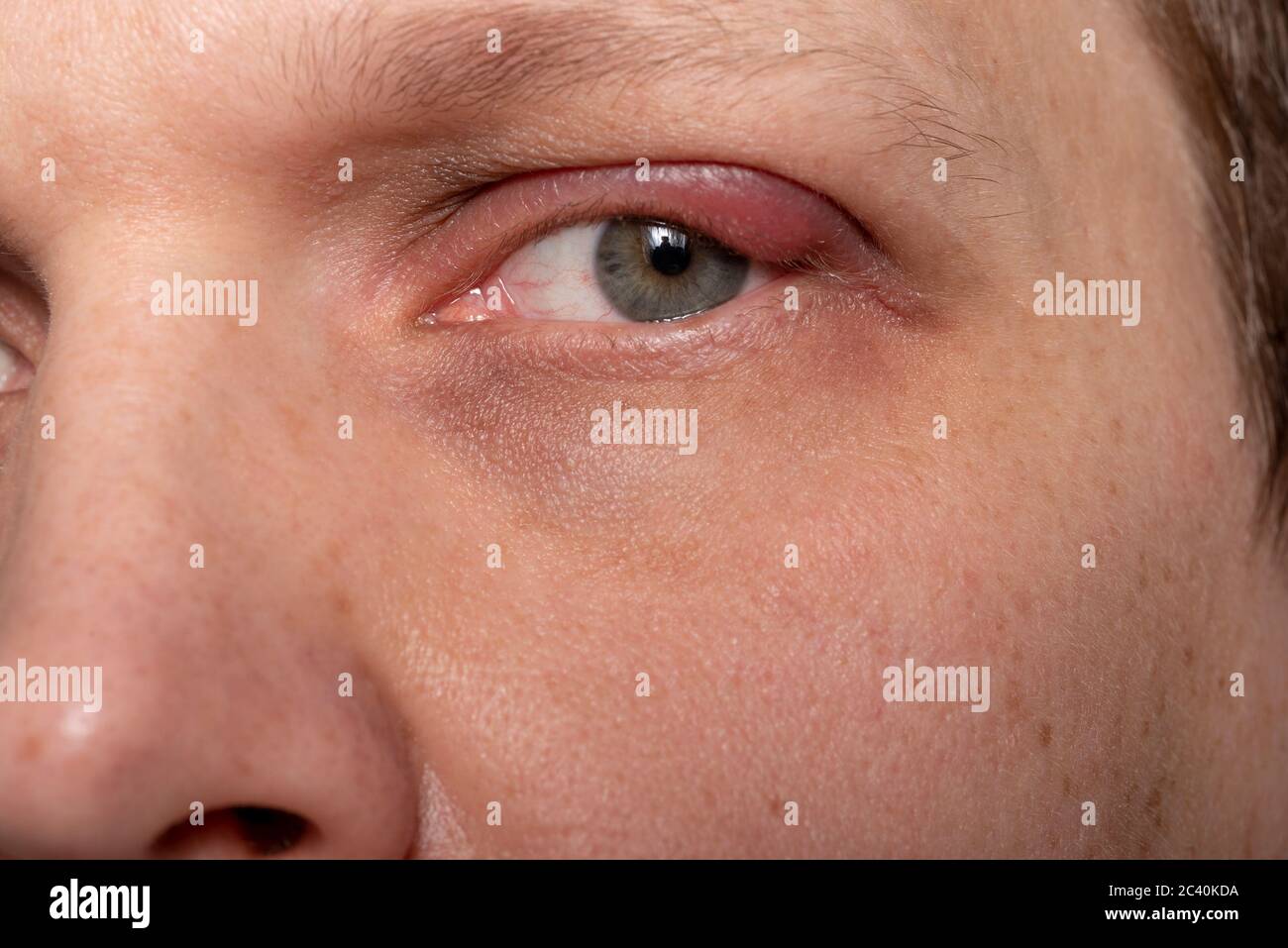Schließen Sie den oberen linken Lidabszess. Auge mit Gerste. Gerstenerkrankungen, das Konzept der Krankheitsentwicklung. Stockfoto