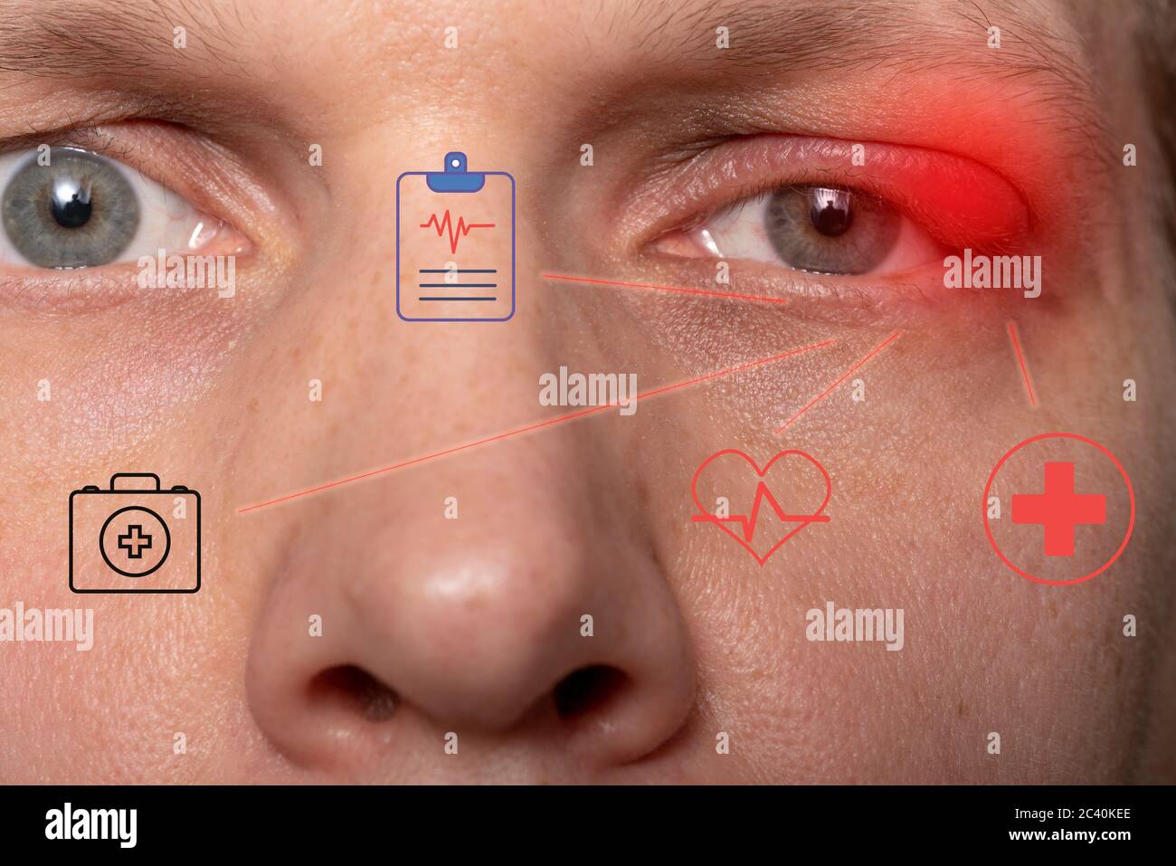 Schließen Sie den oberen linken Lidabszess. Auge mit Gerste. Gerstenerkrankungen, das Konzept der Krankheitsentwicklung. Stockfoto