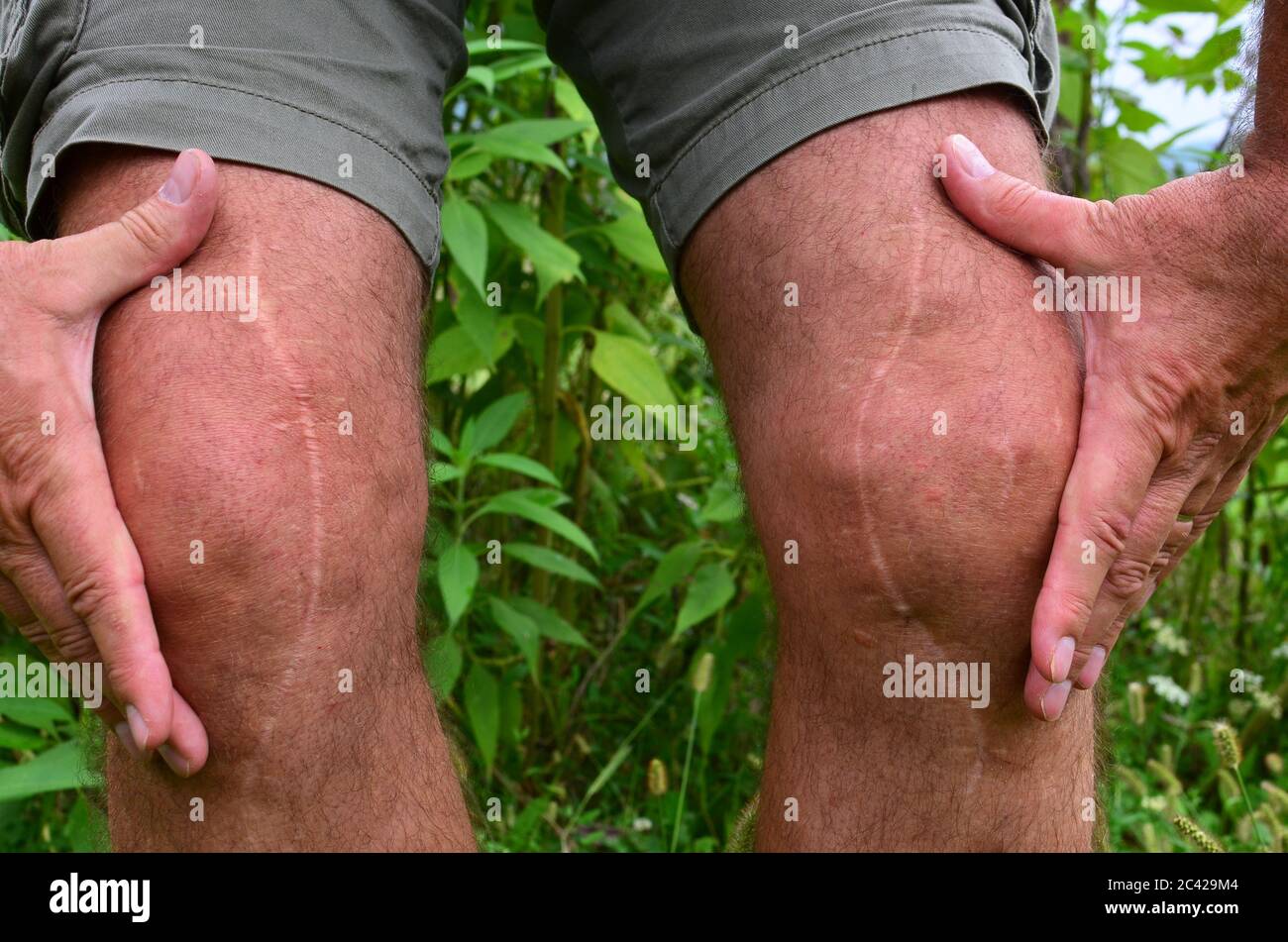 Knee operation scar -Fotos und -Bildmaterial in hoher Auflsung  Alamy