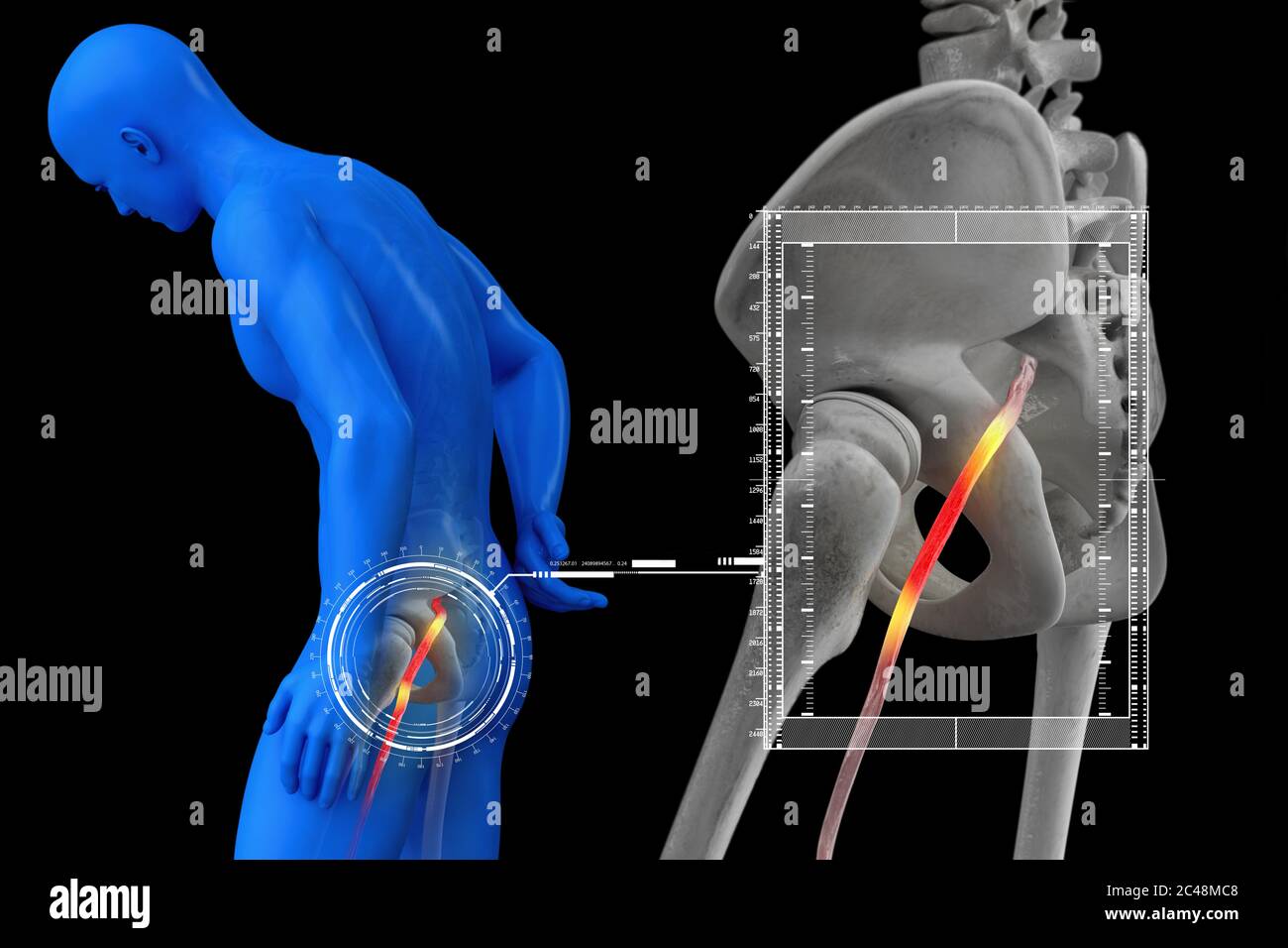 Geknickte menschlichen Ischiasnerv, anatomische Vision. 3d-Illustration. Stockfoto