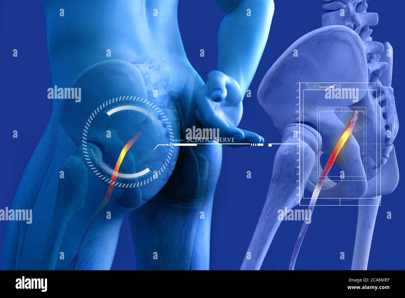Geknickte menschlichen Ischiasnerv, anatomische Vision. 3d-Illustration. Stockfoto