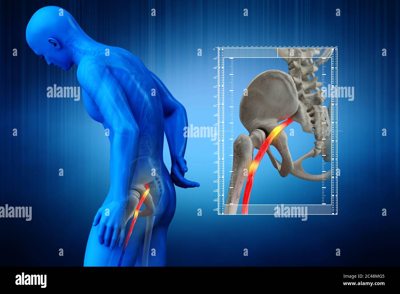 Geknickte menschlichen Ischiasnerv, anatomische Vision. 3d-Illustration. Stockfoto