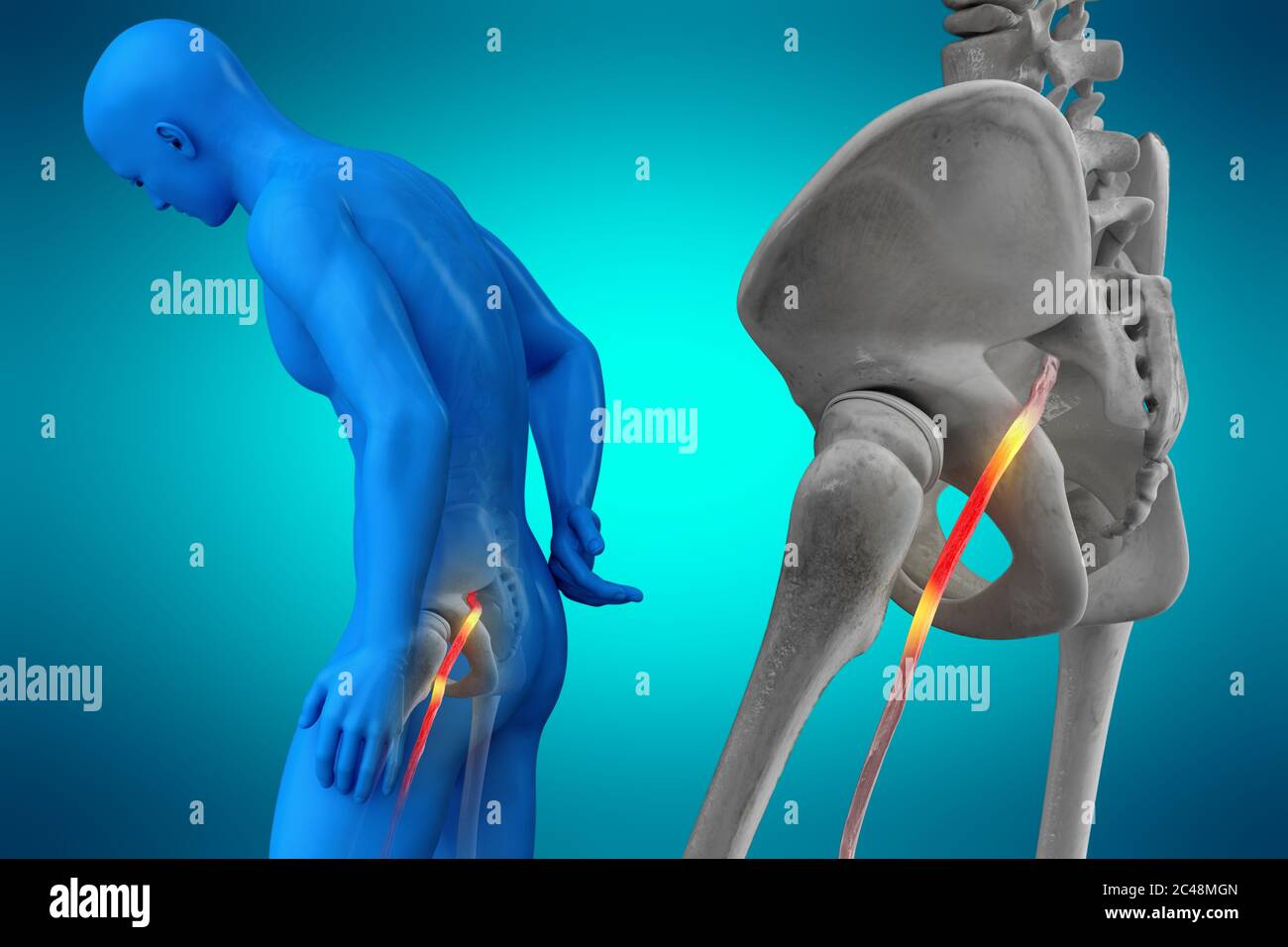 Geknickte menschlichen Ischiasnerv, anatomische Vision. 3d-Illustration. Stockfoto