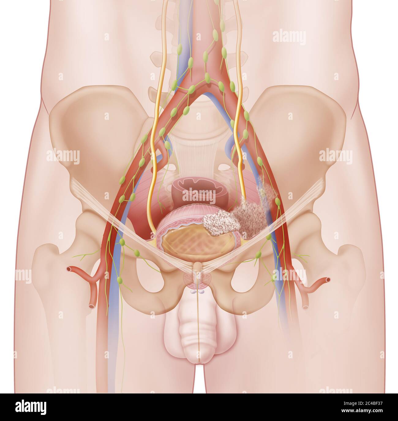 Stadium IV Blasenkrebs, Tumorinvasion, Metastasen. Diese medizinische Abbildung stellt Blasenkrebs im Stadium IV (Primärkrebs) dar. Die Blase ist sho Stockfoto