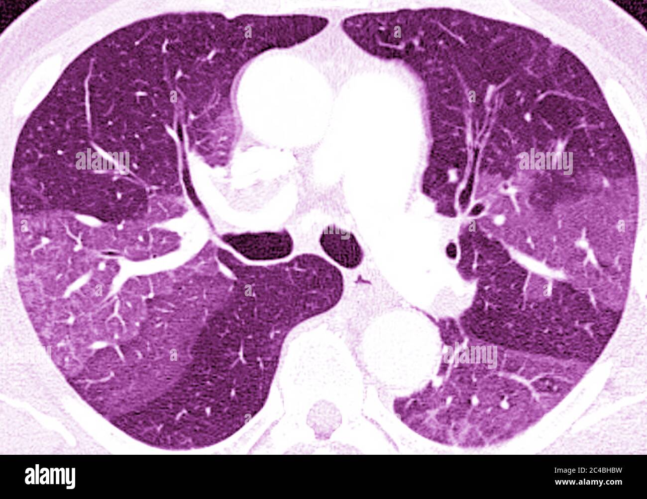 Lungenfibrose (Läsion der Lunge, gekennzeichnet durch das Vorhandensein von überschüssigem faserigem Bindegewebe). Viele Pathologien sind beteiligt, einschließlich c Stockfoto
