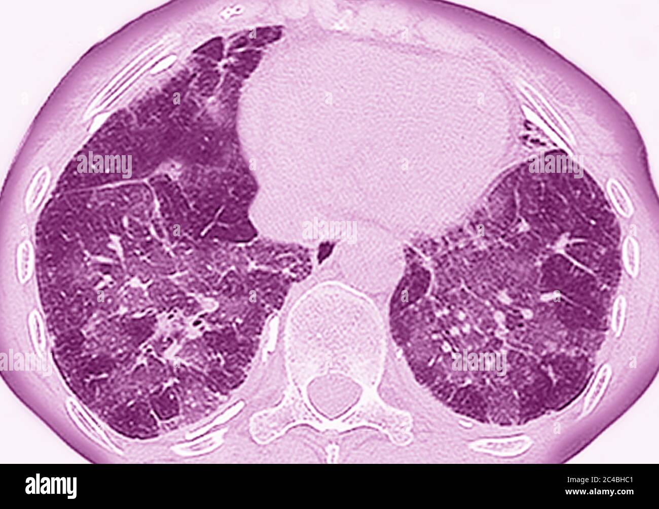 Lungenfibrose (Läsion der Lunge, gekennzeichnet durch das Vorhandensein von überschüssigem faserigem Bindegewebe). Viele Pathologien sind beteiligt, einschließlich c Stockfoto