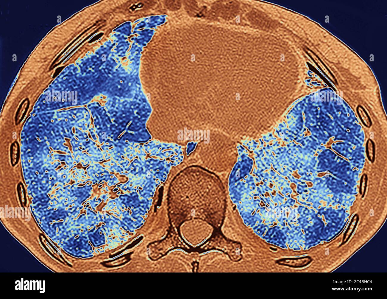 Lungenfibrose (Läsion der Lunge, gekennzeichnet durch das Vorhandensein von überschüssigem faserigem Bindegewebe). Viele Pathologien sind beteiligt, einschließlich c Stockfoto