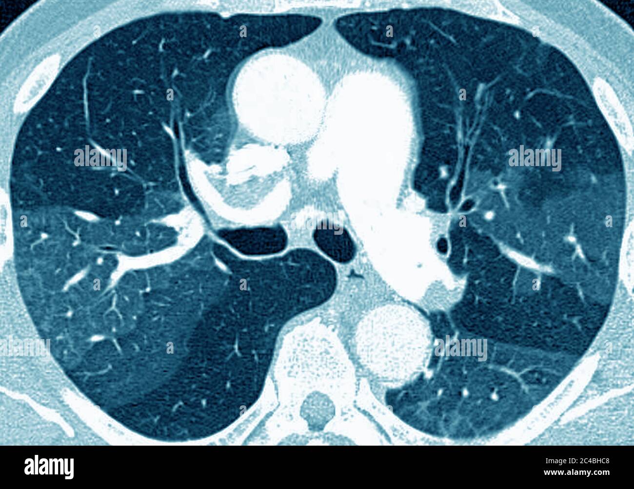 Lungenfibrose (Läsion der Lunge, gekennzeichnet durch das Vorhandensein von überschüssigem faserigem Bindegewebe). Viele Pathologien sind beteiligt, einschließlich c Stockfoto