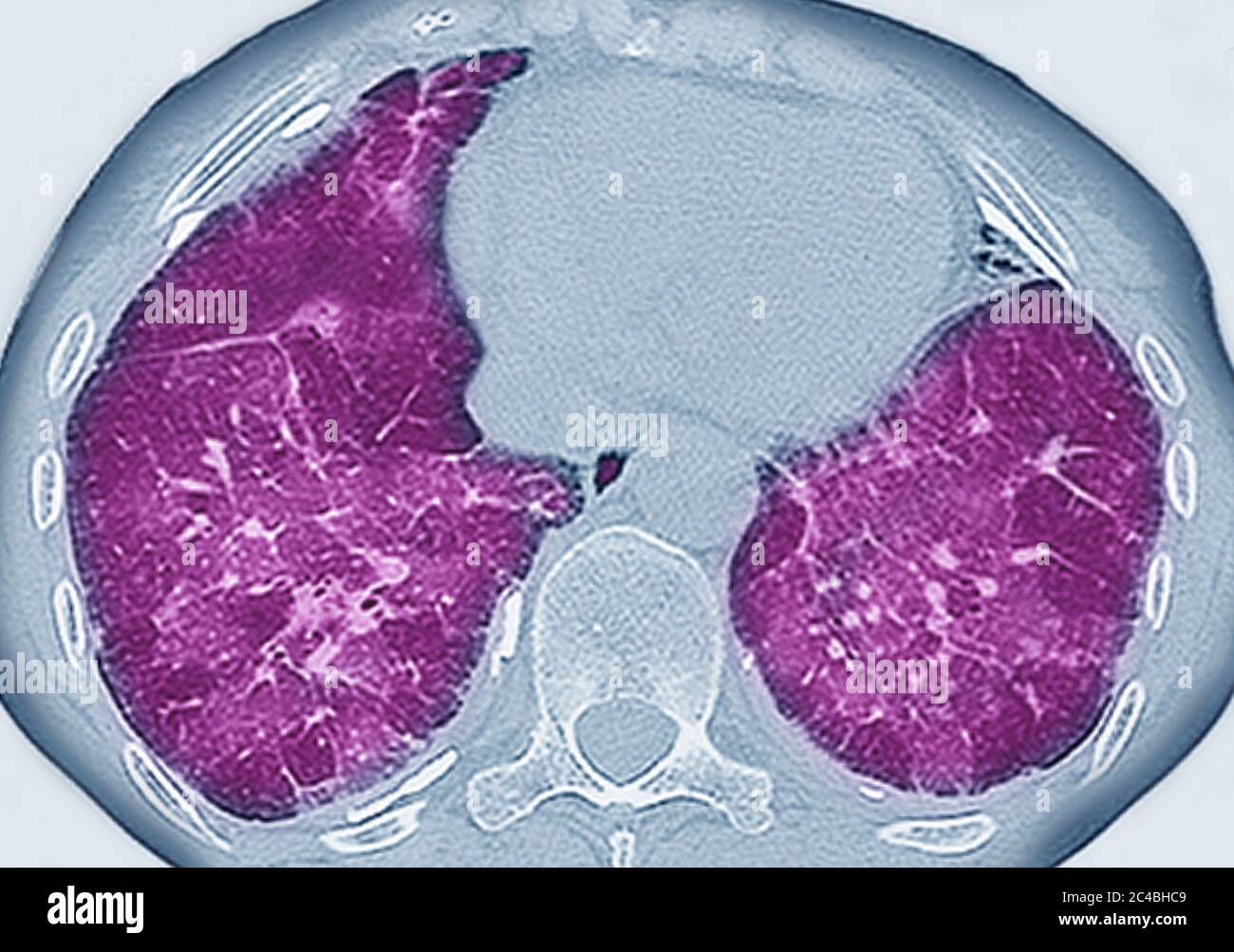 Lungenfibrose (Läsion der Lunge, gekennzeichnet durch das Vorhandensein von überschüssigem faserigem Bindegewebe). Viele Pathologien sind beteiligt, einschließlich c Stockfoto