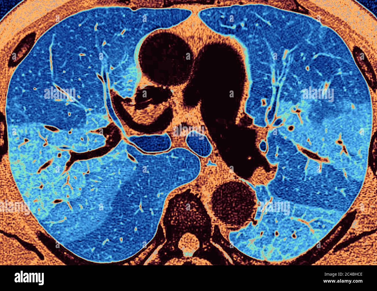 Lungenfibrose (Läsion der Lunge, gekennzeichnet durch das Vorhandensein von überschüssigem faserigem Bindegewebe). Viele Pathologien sind beteiligt, einschließlich c Stockfoto