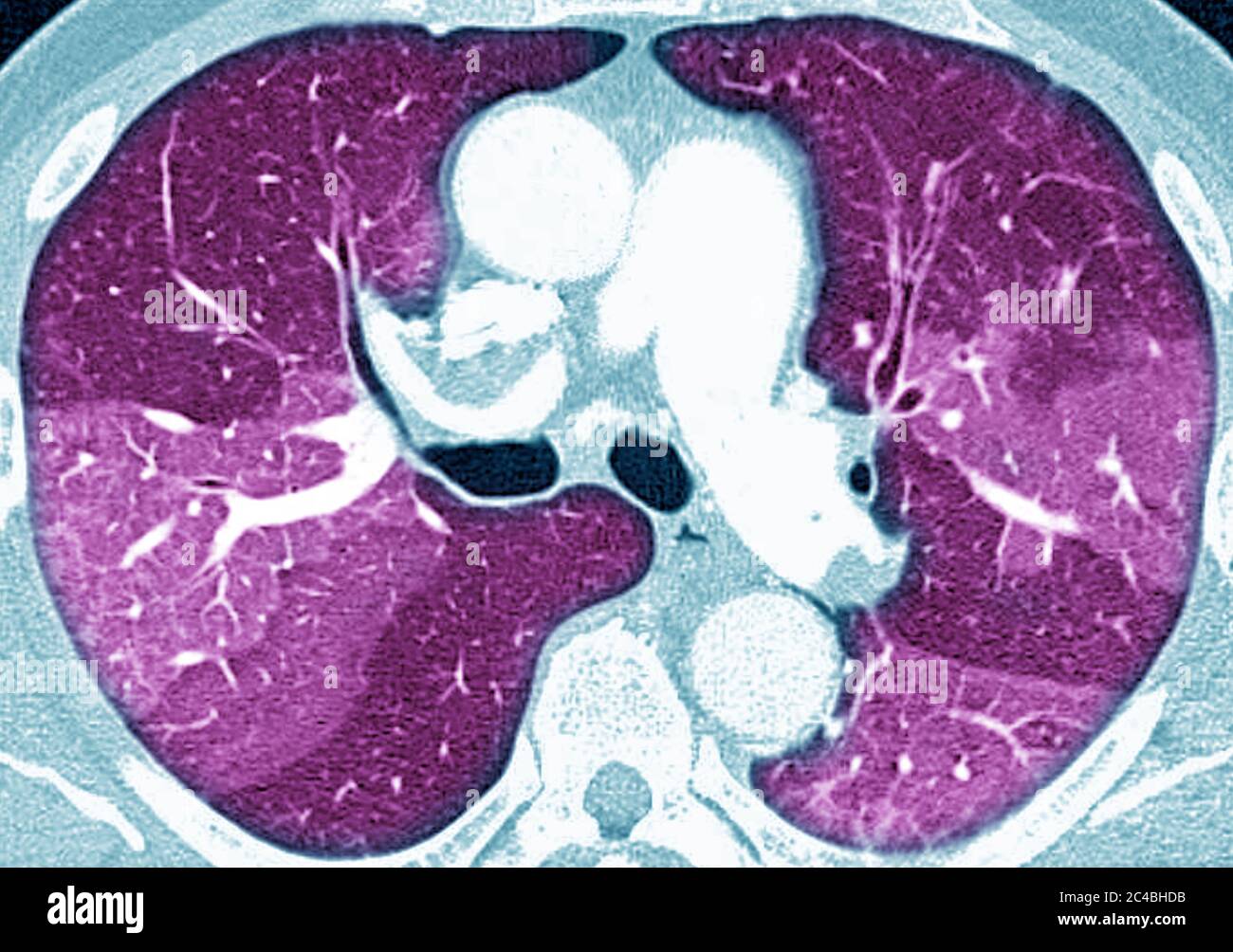 Lungenfibrose (Läsion der Lunge, gekennzeichnet durch das Vorhandensein von überschüssigem faserigem Bindegewebe). Viele Pathologien sind beteiligt, einschließlich c Stockfoto
