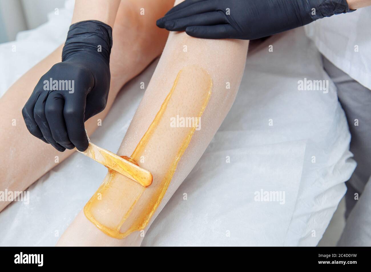 Eine Hand in einem schwarzen Latexhandschuh trägt gelbes Wachs auf ein unrasiert Bein auf. Stockfoto