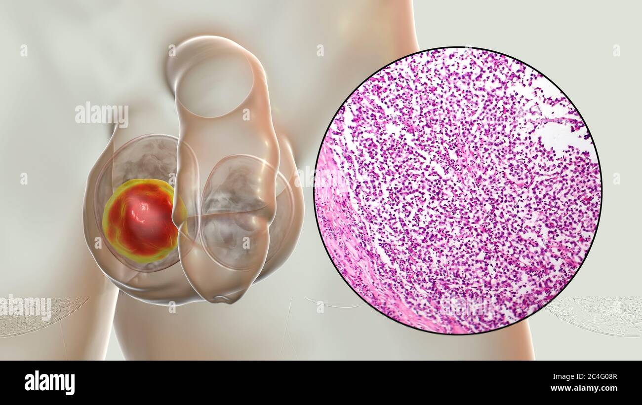 Hodenkrebs, ein maligner Spermatozytenvorfall, Computerdarstellung und leichte Mikrograph. Ein Seminom ist ein bösartiger Tumor (Krebs) des Hodens (Hoden). Obwohl es sich um eine seltene Krebserkrankung handelt, ist sie die häufigste Krebserkrankung bei 15 bis 35-jährigen Männern. Es entsteht aus abnormen Keimzellen (Vorläufer zu Spermien) in den seminiferösen Tubuli. Die chirurgische Entfernung des betroffenen Hodens (Orchidektomie) wird bei Bedarf durch Strahlentherapie und Chemotherapie begleitet. Stockfoto