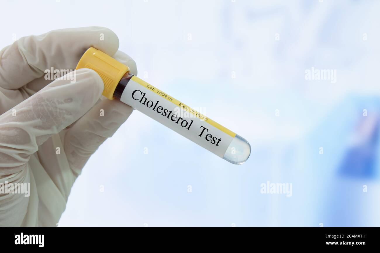 Arzt, der im Labor das Probenröhrchen mit dem Etikett für den Cholesterintest hält. Stockfoto