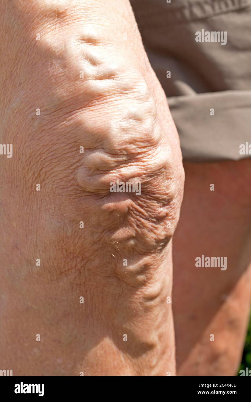Geschwollene Krampfadern auf dem Knie der älteren Frau Großbritannien Stockfoto