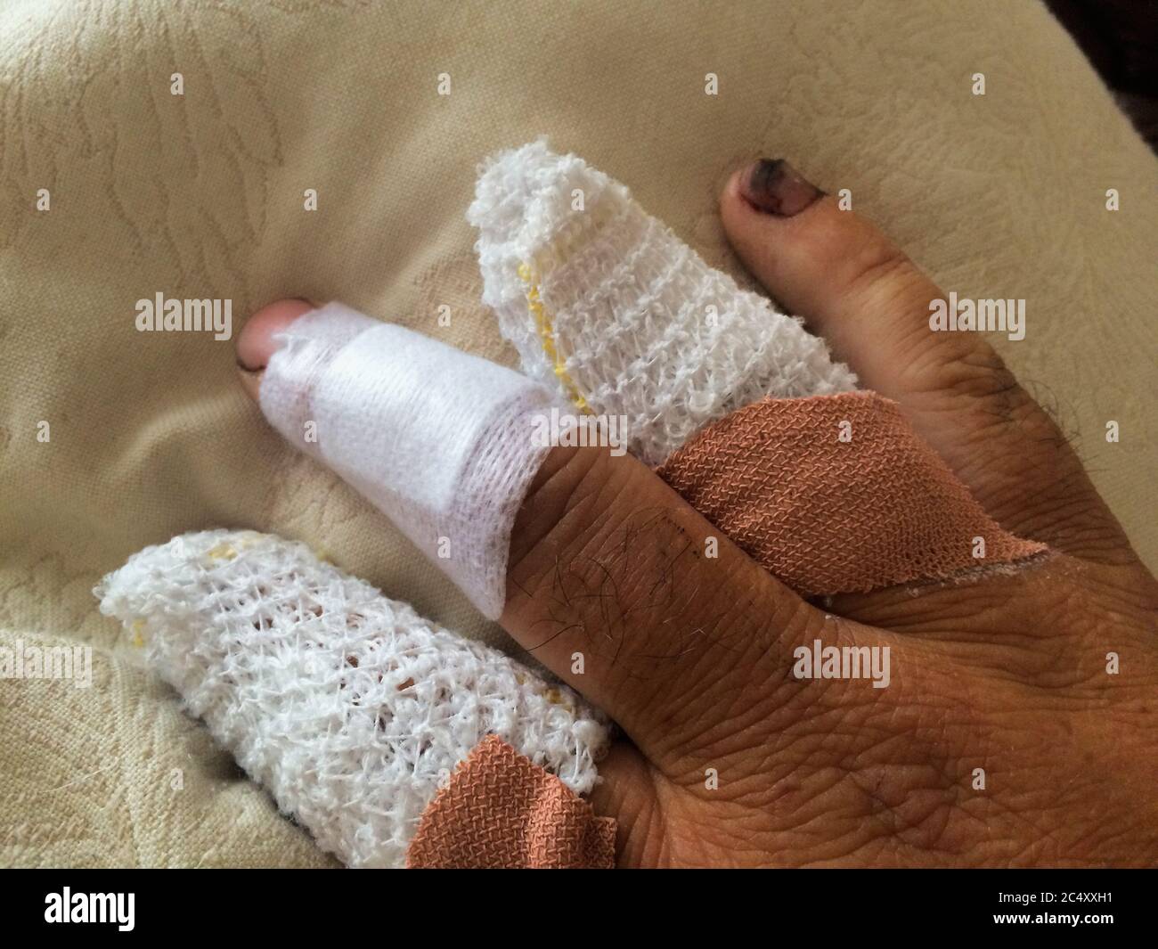 Rechte Hand mit Bandagen und Gips auf den Fingern nach Verlust des oberen Teils des Ringfingers nach Unfall mit Propeller Stockfoto