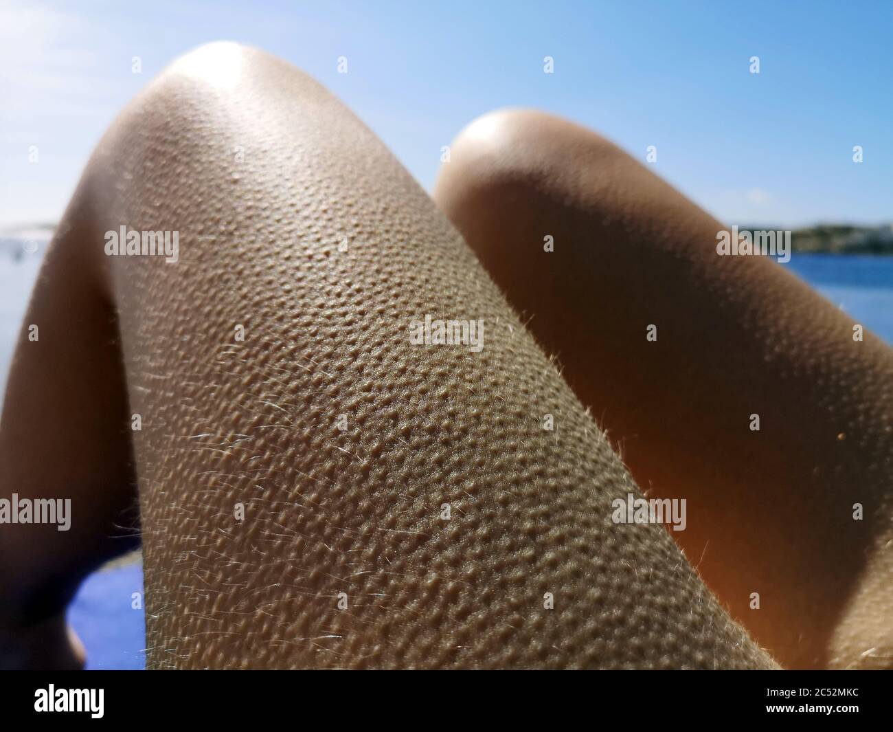 Gaensehaut in einem bein