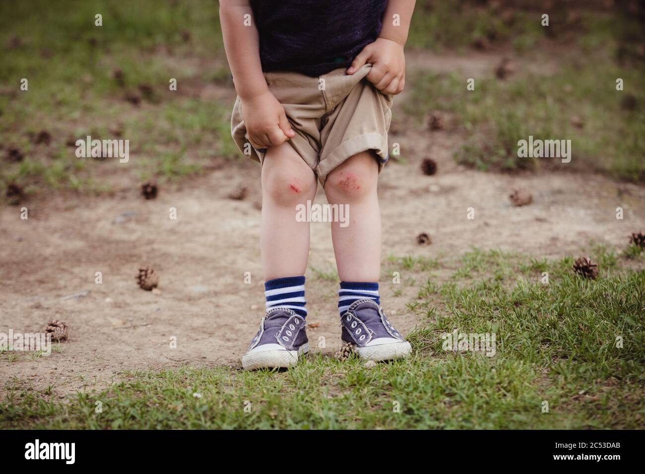 Kleiner Junge in Shorts zeigt seine gebrochenen Kinderknees Stockfoto