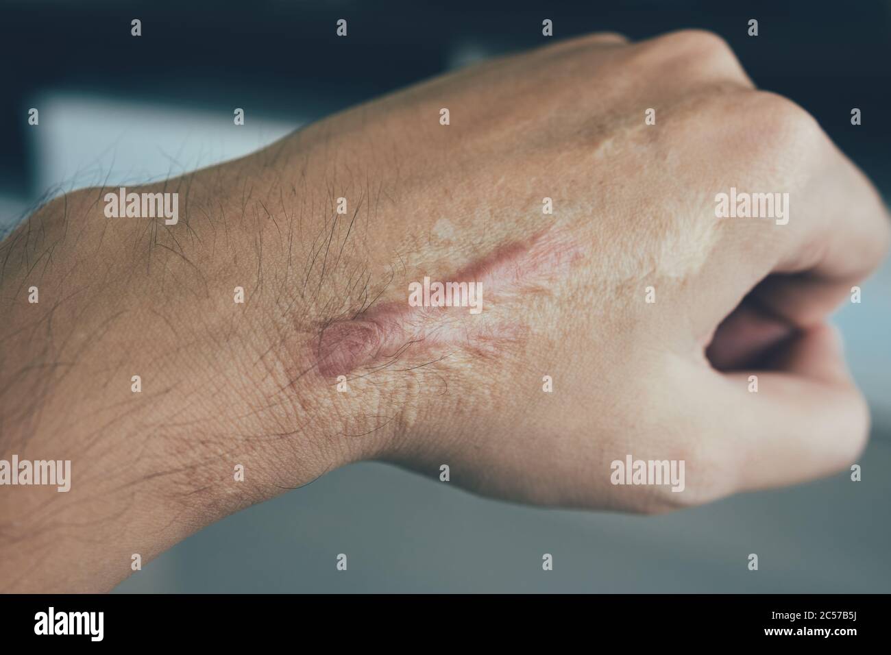 Narbe auf der menschlichen Haut Keloid auf der Hand. Stockfoto