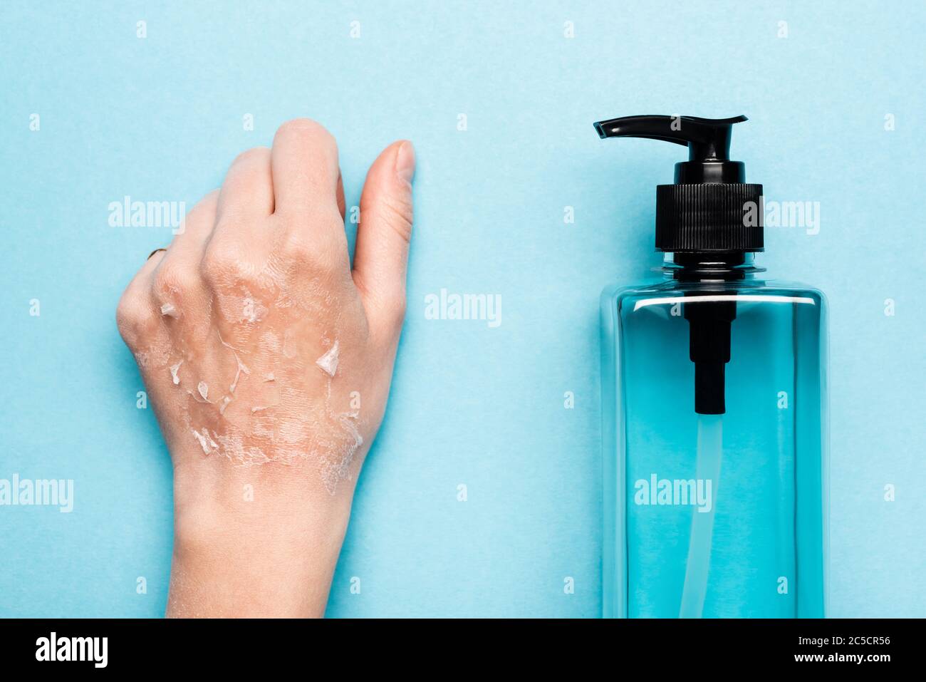 Teilansicht der weiblichen Hand mit Peeling, trockene Haut in der Nähe von Desinfektionsmittel auf blau Stockfoto