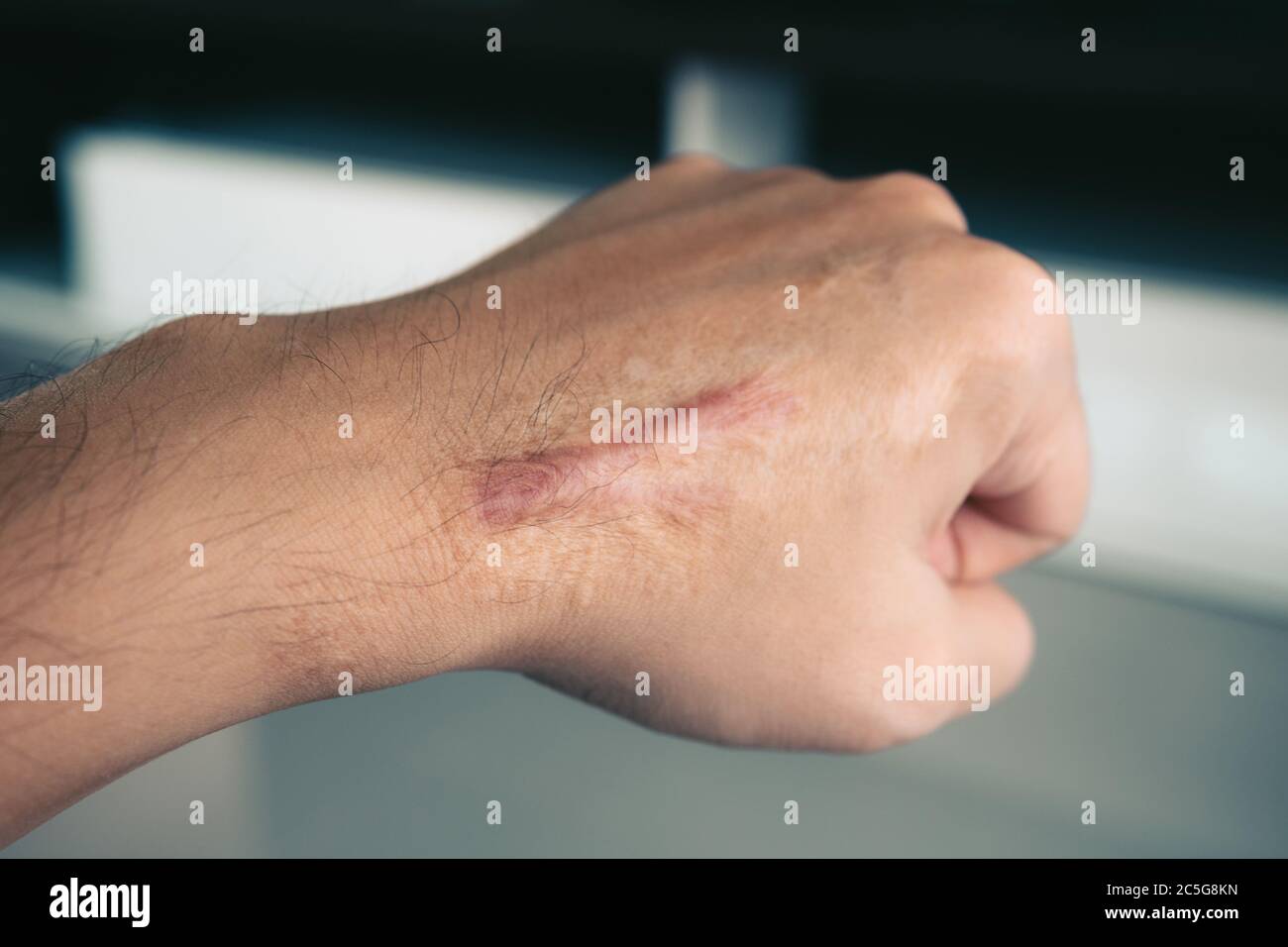 Narbe auf der menschlichen Haut Keloid auf der Hand. Stockfoto