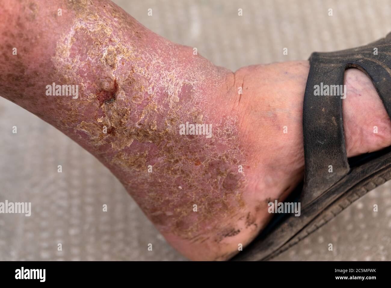 Nahaufnahme einer infizierten Wunde zu Fuß Stockfoto