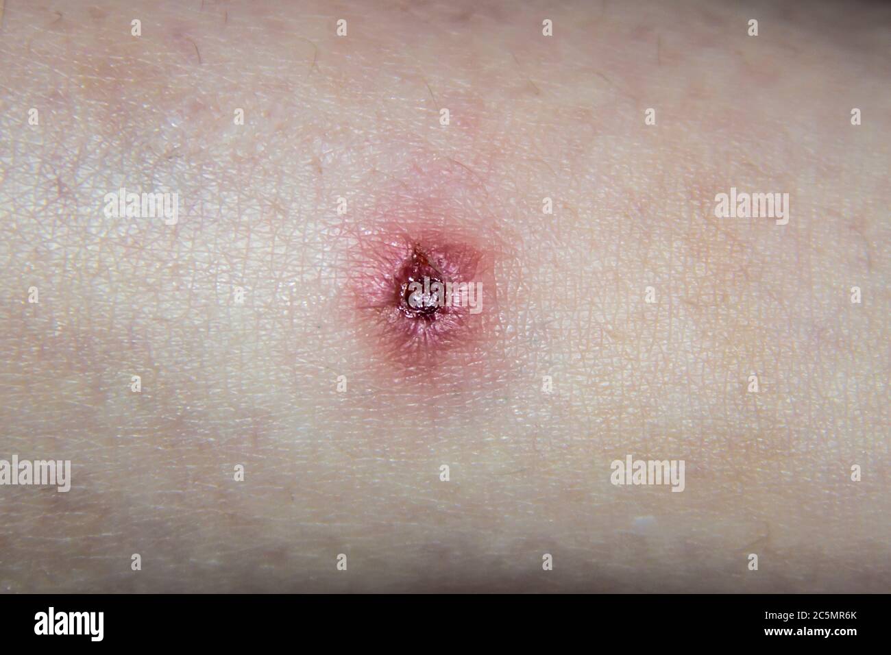 Wie Sieht Eine Infizierte Wunde Aus www.alamy.de