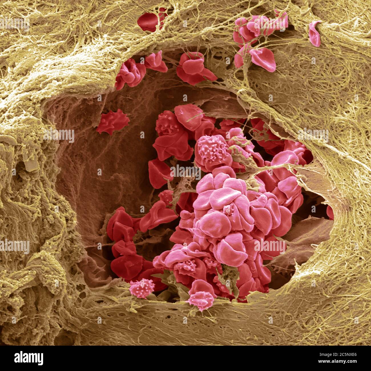 Blutgefäß der Haut. Farbiger Rasterelektronenmikrograph (SEM) eines Blutgefäßes (Arteriole) in der Dermis der Haut. Im Blutgefäß befinden sich rote Blutkörperchen (Erythrozyten, rot), die Sauerstoff um den Körper transportieren. Einige dieser roten Blutkörperchen sind zenkreniert. Das Blutgefäß ist von Bindegewebe umgeben, das der Haut ihren Ton und ihre Elastizität verleiht. Vergrößerung: 1000 bei 10 Zentimeter Breite. Stockfoto