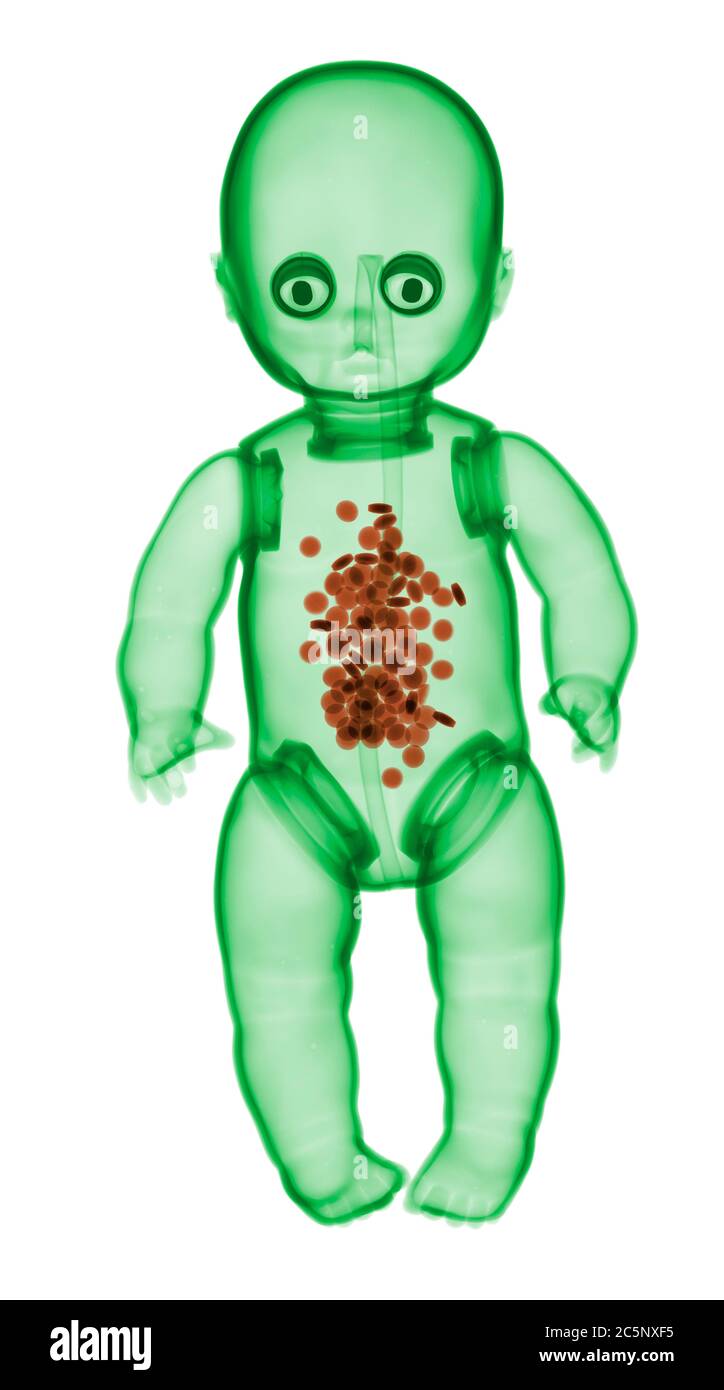 Puppe mit Pillen im Inneren, farbige Röntgenstrahlen. Stockfoto