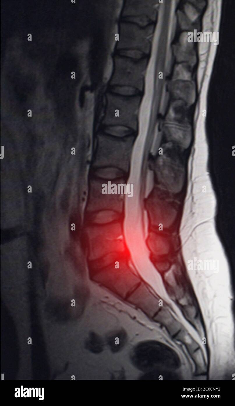 Bild nach Untersuchung der Magnetresonanztomographie. Konzept der Wirbelsäulenuntersuchung, Otseochondrose, lumbale Bandscheibenvorfall Stockfoto