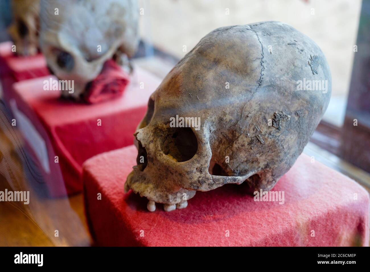 Paracas alten verlängerten menschlichen Schädel mit kranialer Deformation durch kraniale Bindung, Chivay, Peru Stockfoto