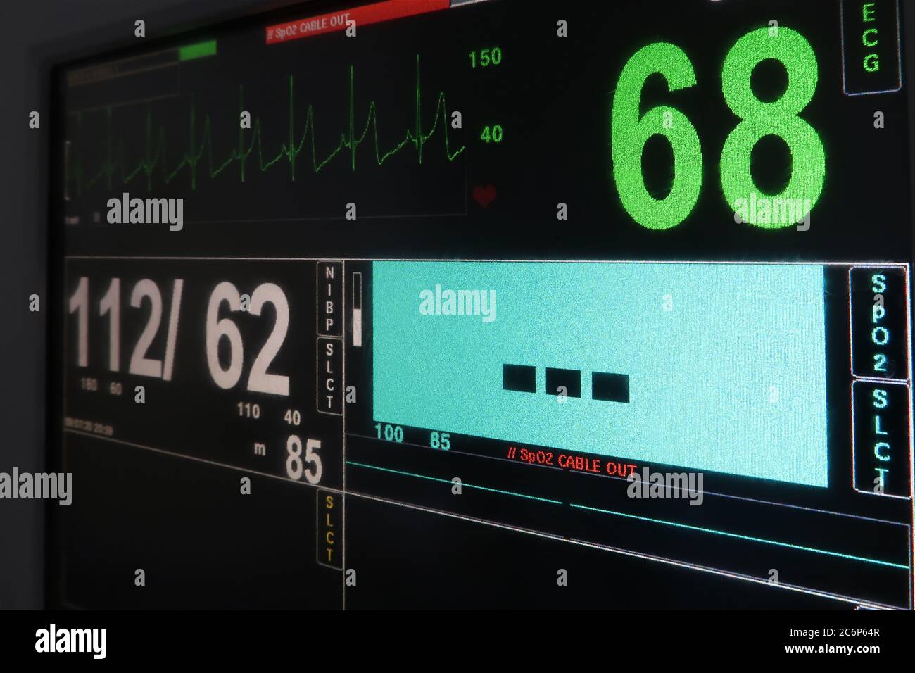 Bildschirm des Monitors Elektrokardiogramm (EKG) Stockfoto