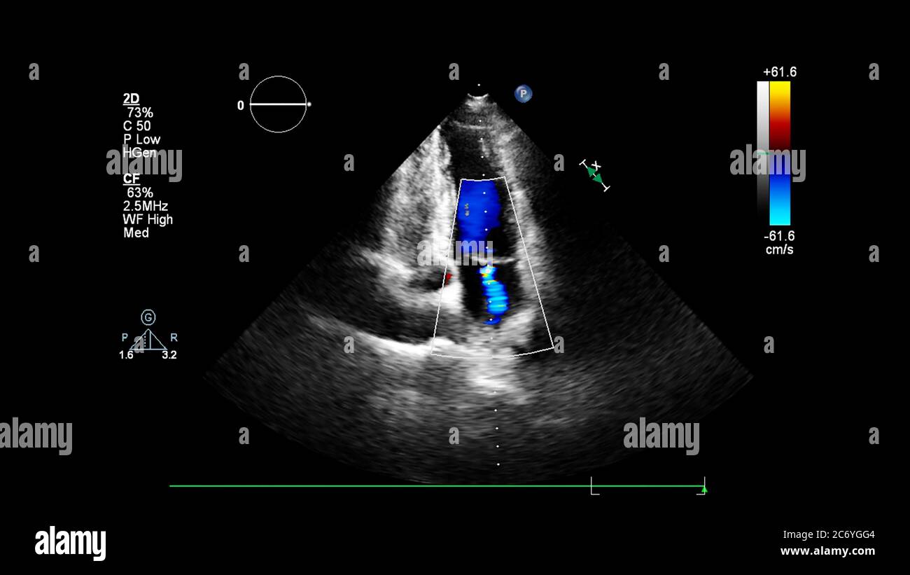 Bild des Herzens während des transösophagealen Ultraschalls mit Doppler-Modus. Stockfoto