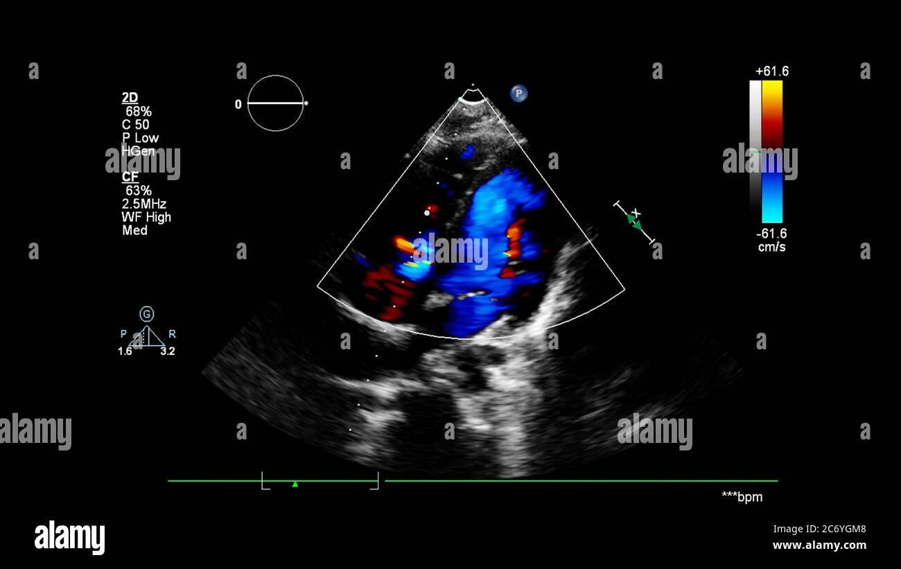 Bild des Herzens während des transösophagealen Ultraschalls mit Doppler-Modus. Stockfoto