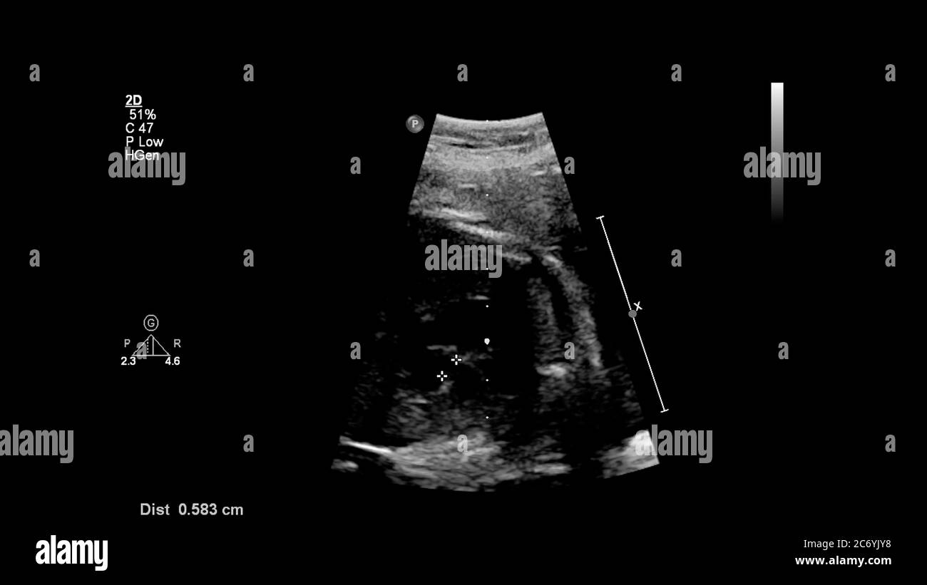 Fetal Stockfotos Und Bilder Kaufen Seite 3 Alamy