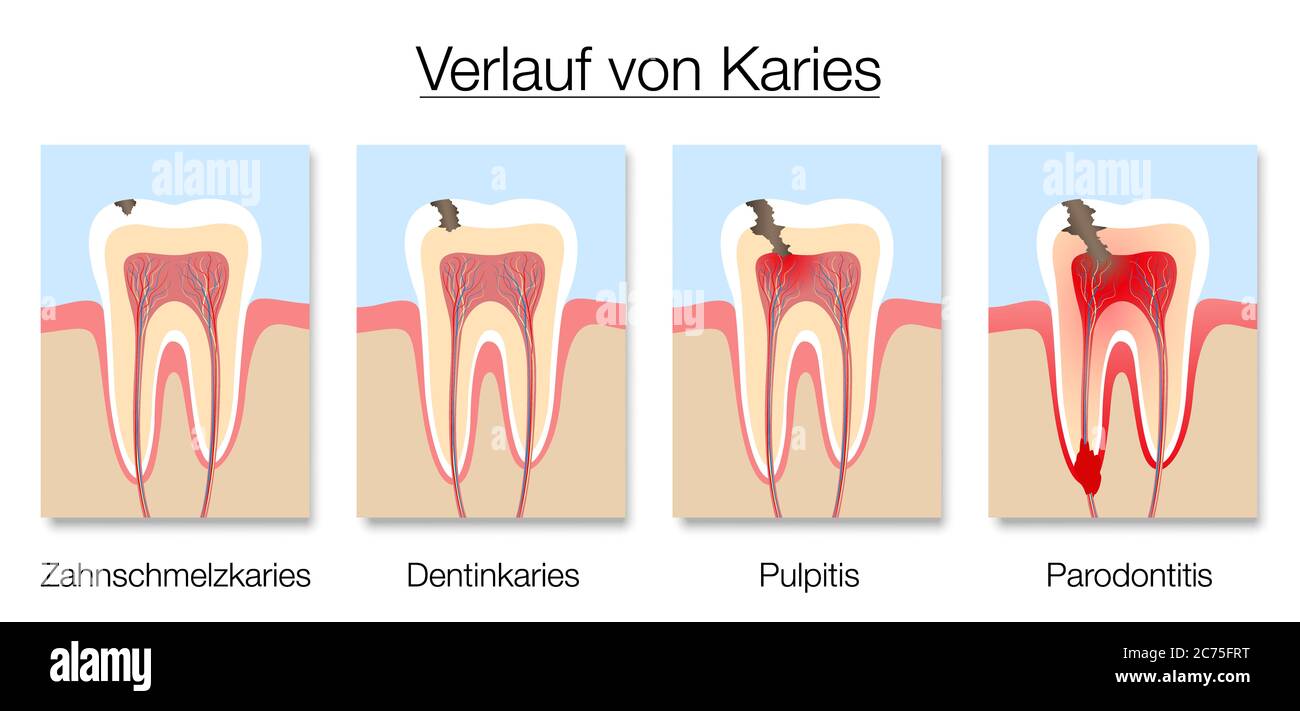 Kariesstadien Infografik, deutsche Kennzeichnung, Entwicklung von Karies mit Zahnschmelz und Dentin Karies, Pulpitis und Parodontitis. Stockfoto