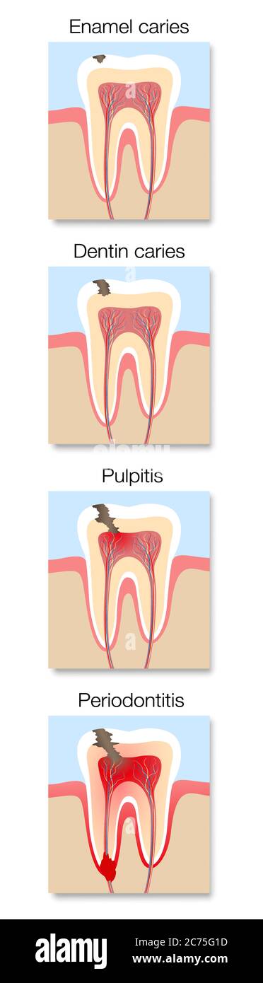 Kariesentwicklung Infografik, Stadien mit Querschnitt von Karies mit Zahnschmelz und Dentin Karies, Pulpitis und Parodontitis. Stockfoto