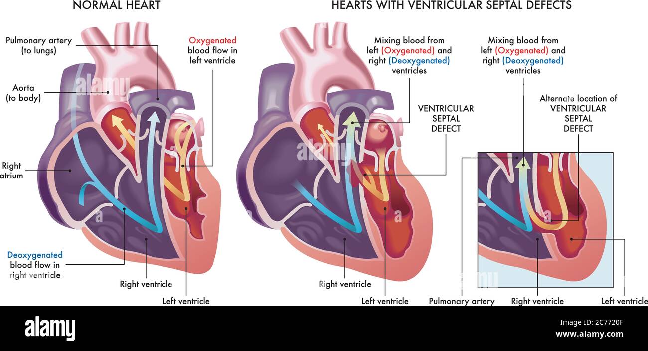 Medizinische Illustration, die ein normales Herz mit Herzen vergleicht, die von ventrikulären Septumdefekten, einer abnormalen Öffnung (Loch) im Herzen, mit einem befallen sind Stock Vektor