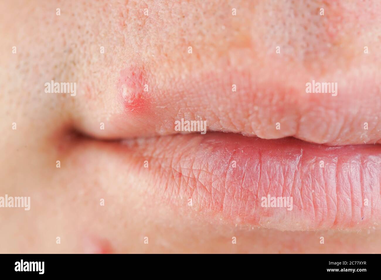 Roter Punkt Auf Der Lippe www.alamy.de
