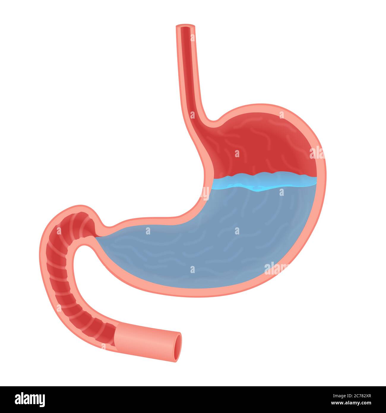 Vektor Medizinische Illustration über Säure im Magen. Magensäure Reflux, Magensäure Stock Vektor