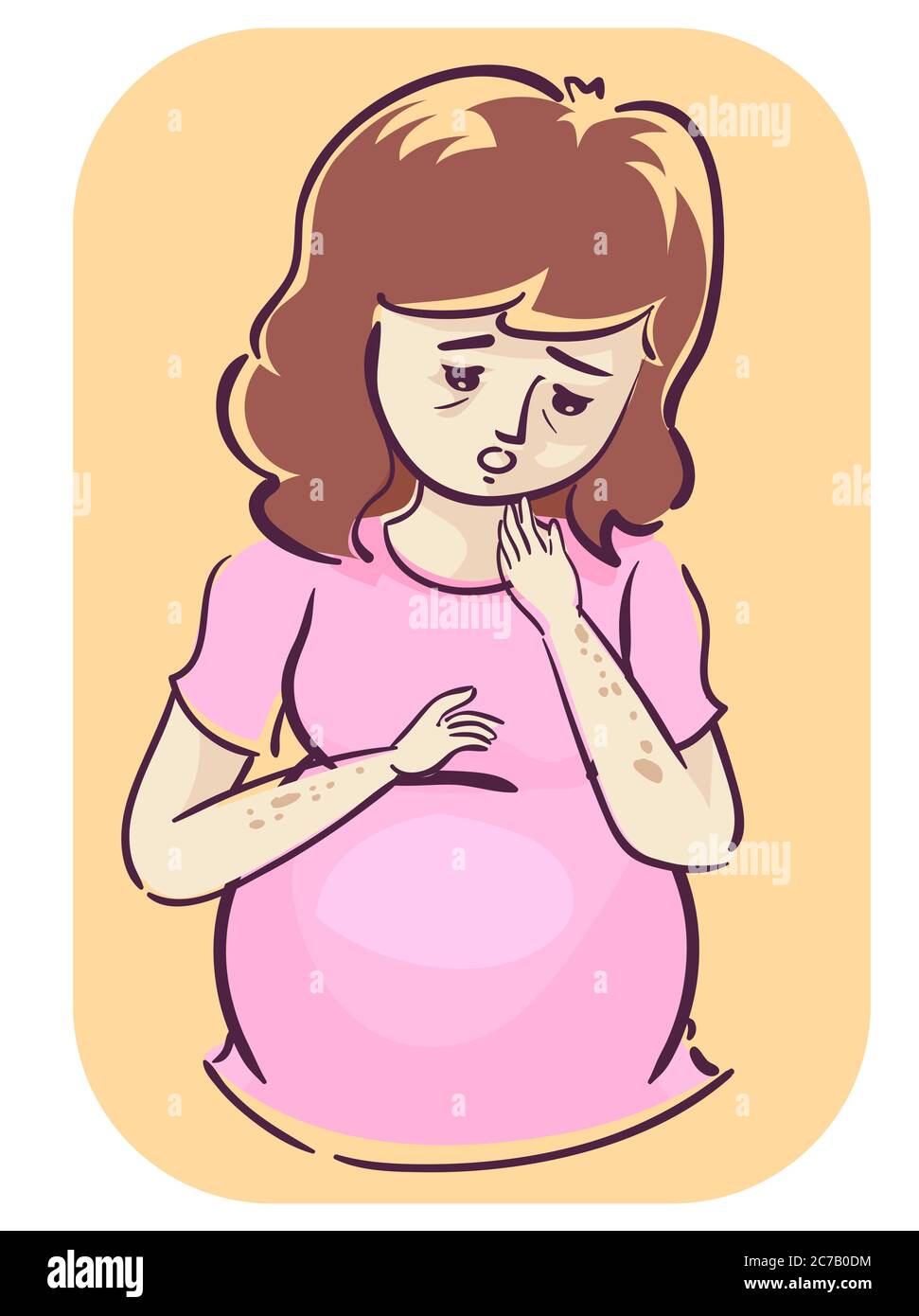 Illustration eines Mädchens schwanger mit schuppigen Flecken auf ihren Armen, Symptom der Hautverfärbung Stockfoto