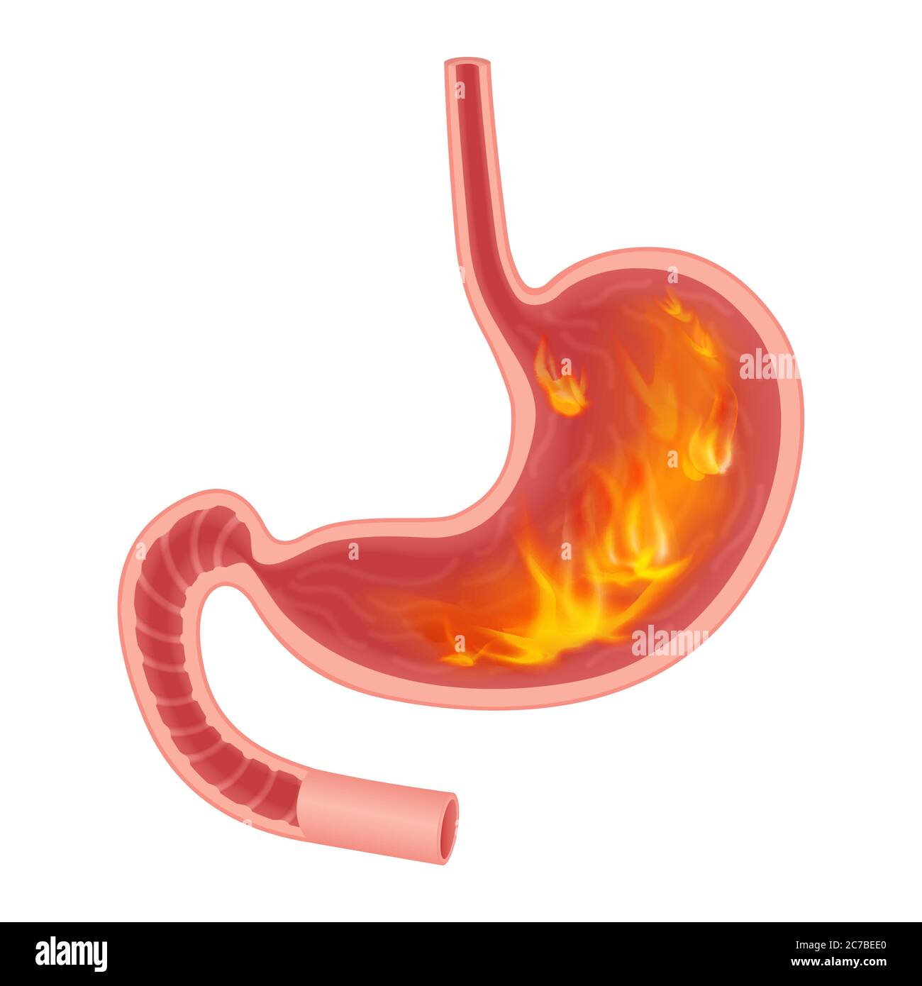 Realistische medizinische Illustration von Pyrosis Magen isoliert. Feuerstörung im Magen Stock Vektor