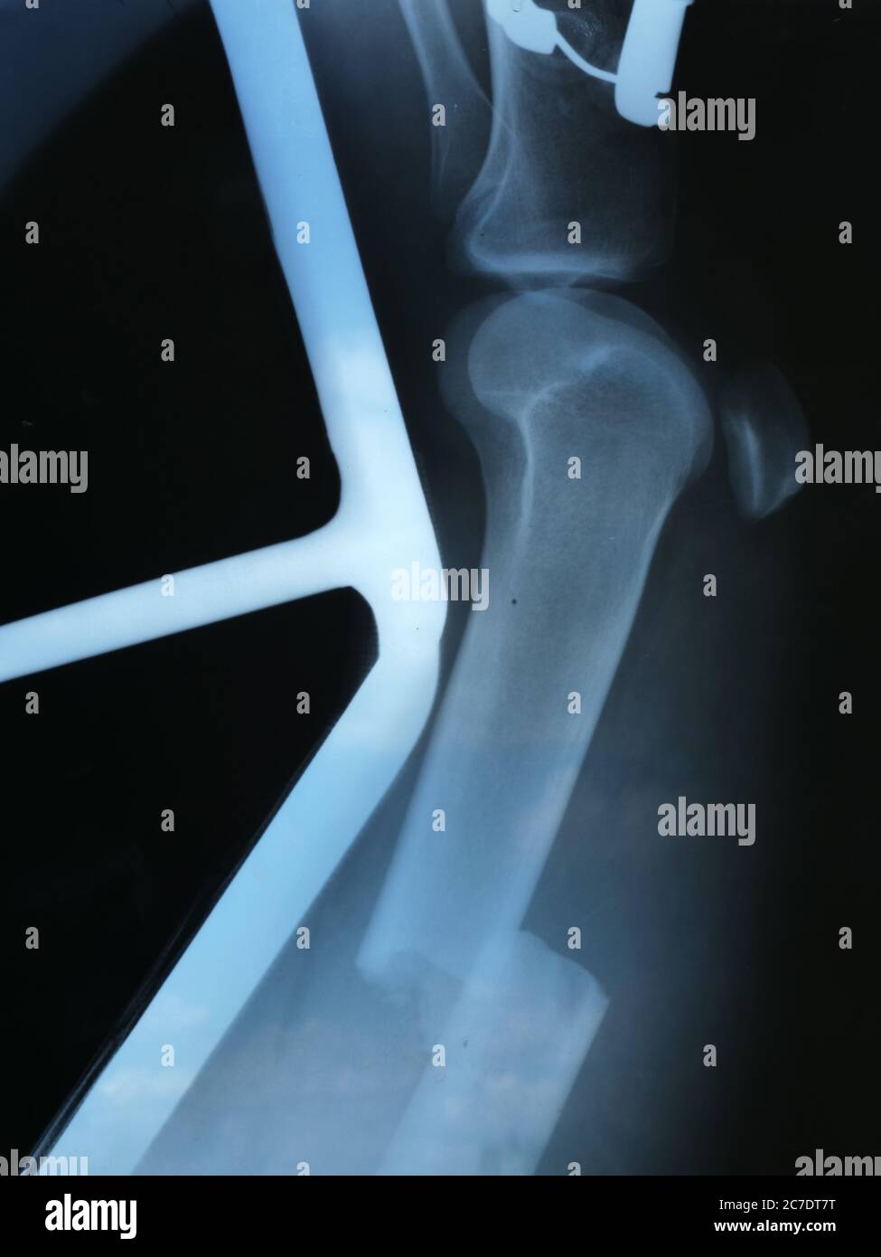 Dieses Stock-Foto zeigt die Röntgenaufnahme eines Fraktures mit Verschiebung. Hochwertige Fotos Stockfoto