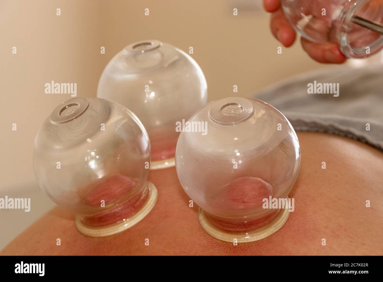 Nahaufnahme von drei Glasvasen, die während der Aufnahme auf die Haut gelegt wurden Eine Massage Stockfoto