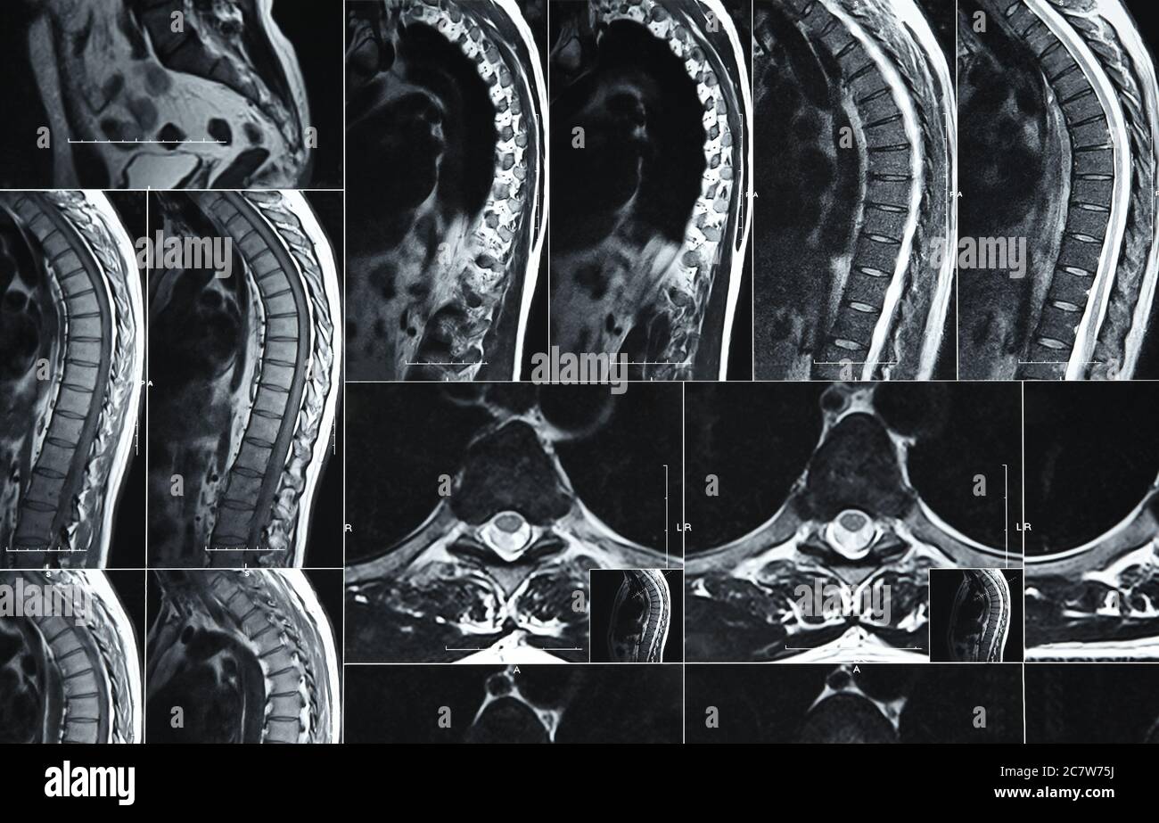 Nahaufnahme der Magnetresonanztomographie oder Computertomographie der menschlichen Lendenwirbelsäule Stockfoto