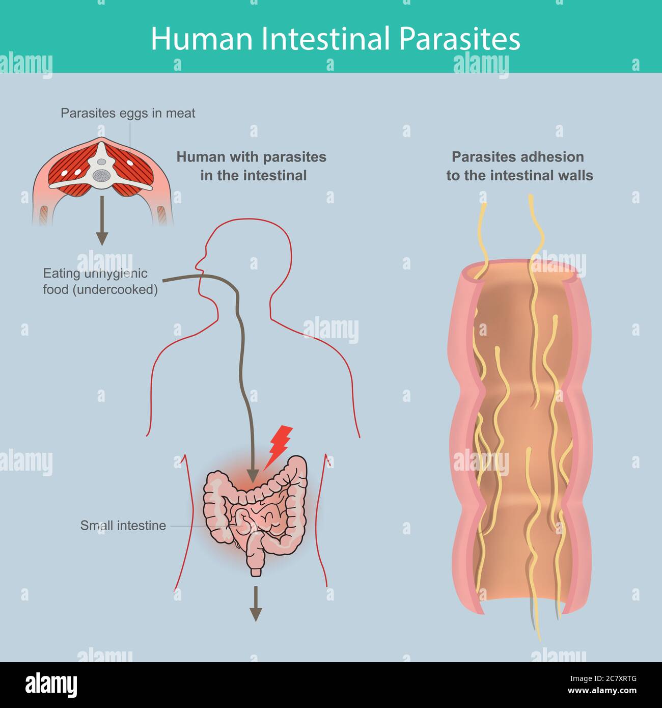 Menschliche Darmparasiten. Illustration erklären die Parasiten im menschlichen Dünndarm von Ursache des Essens infizierten Fleisch oder Parasiten Eier in Fleisch Stock Vektor