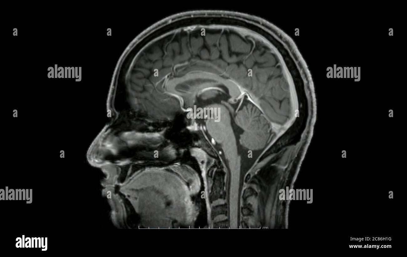 Magnetresonanzbilder des Gehirns (MRT-Gehirn) sagittale Nachkontrast-Sequenz im Cine-Modus, die normale Anatomie zeigt Stockfoto